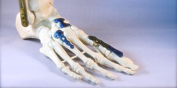 Osteosynthesen, <br>Endoprothesen & Anker Osteosynthesen, <br>Endoprothesen & Anker